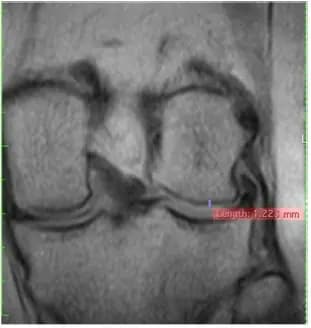 Knee MRI, front view, before treatment